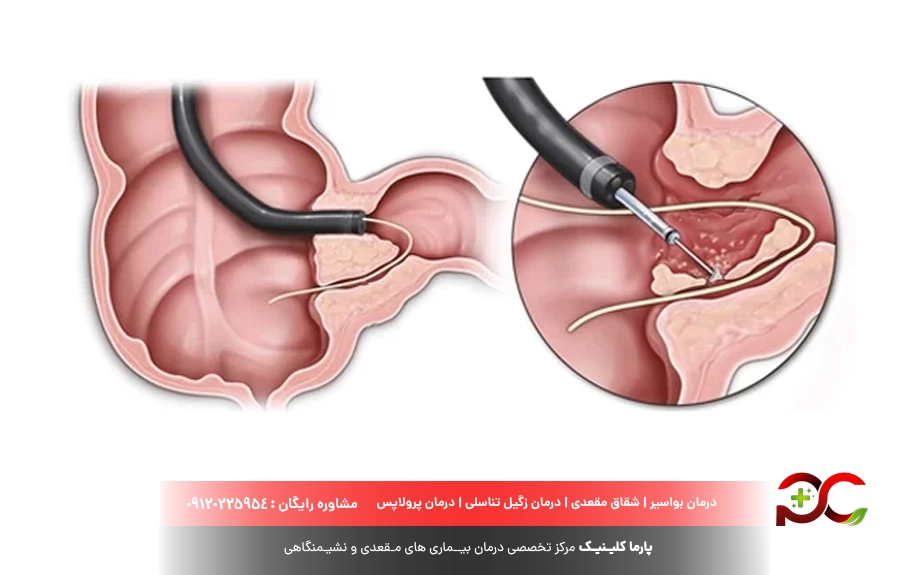 عمل فیستول مقعدی با لیزر