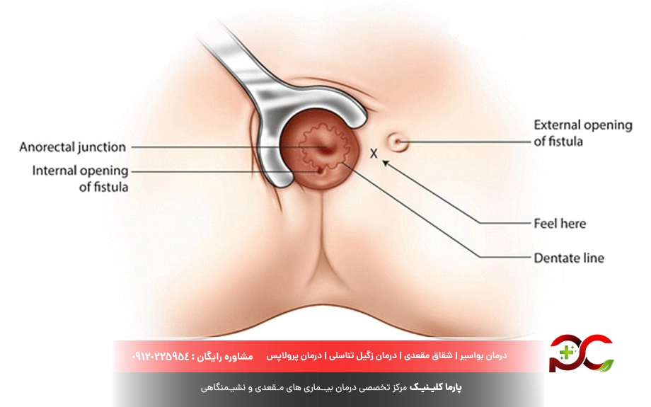 انواع روش درمان و جراحی فیستول