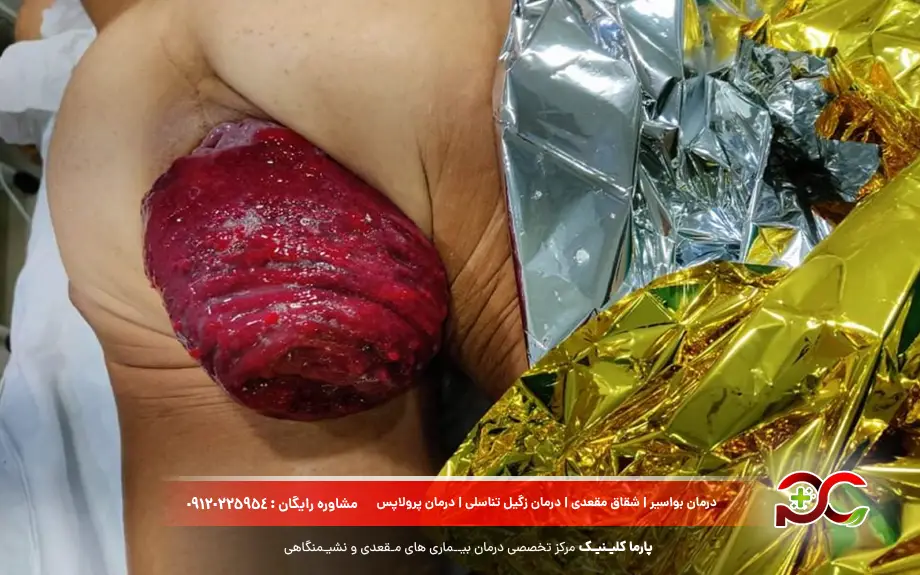 عکس بیرون زدگی روده