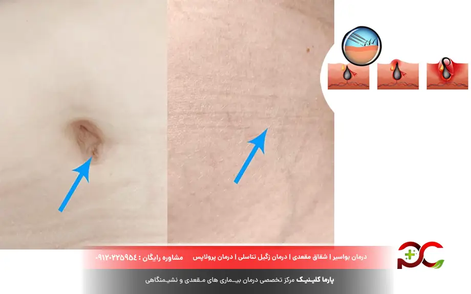 عکس کیست مویی در مراحل اولیه