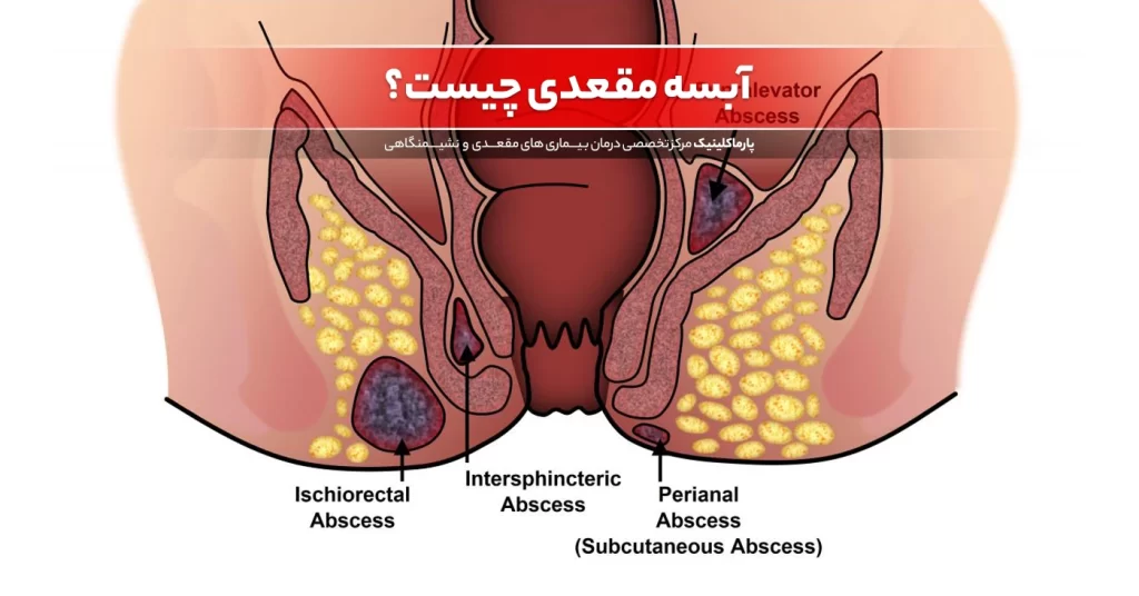 بیماری آبسه مقعدی چیست؟