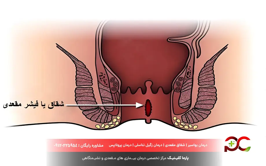 انواع شقاق مقعدی