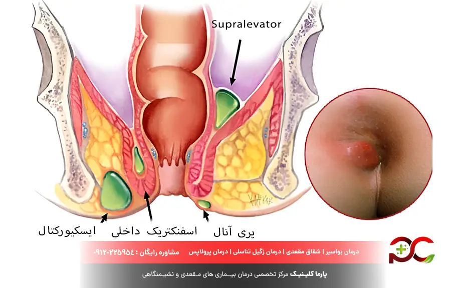 انواع آبسه مقعدی چیست؟
