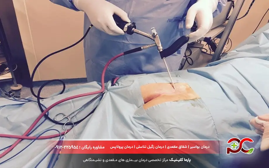 مقایسه درمان کیست مویی در خانه و جراحی