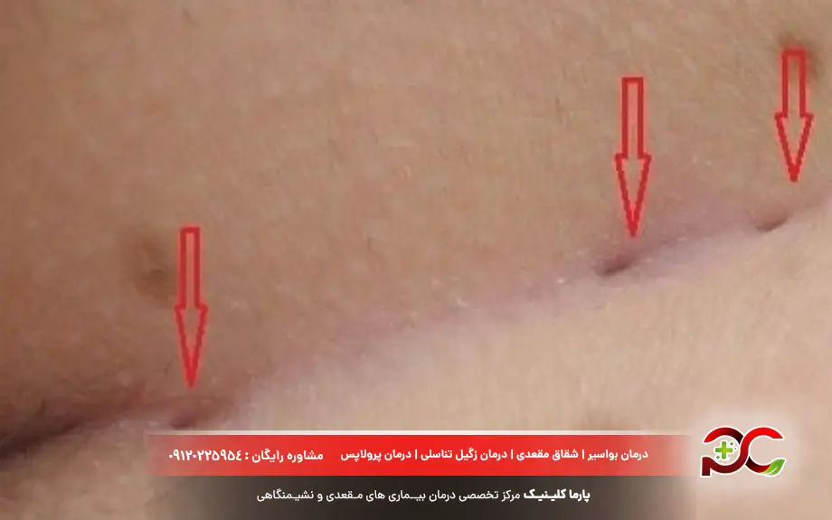 عکس کیست مویی خفیف