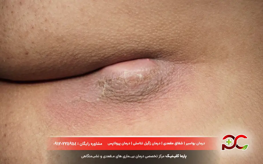 تصویر کیست مویی زنان