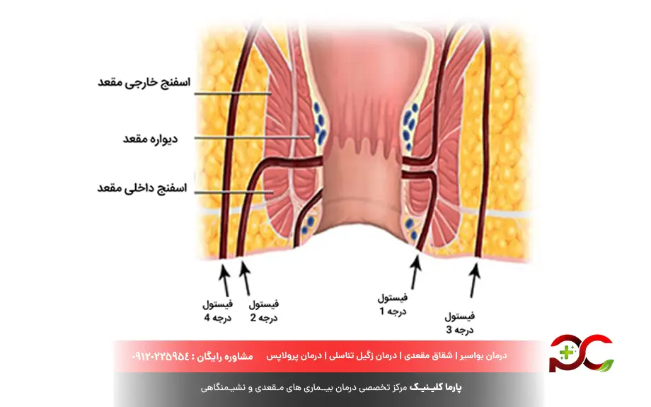 بررسی انواع فیستول