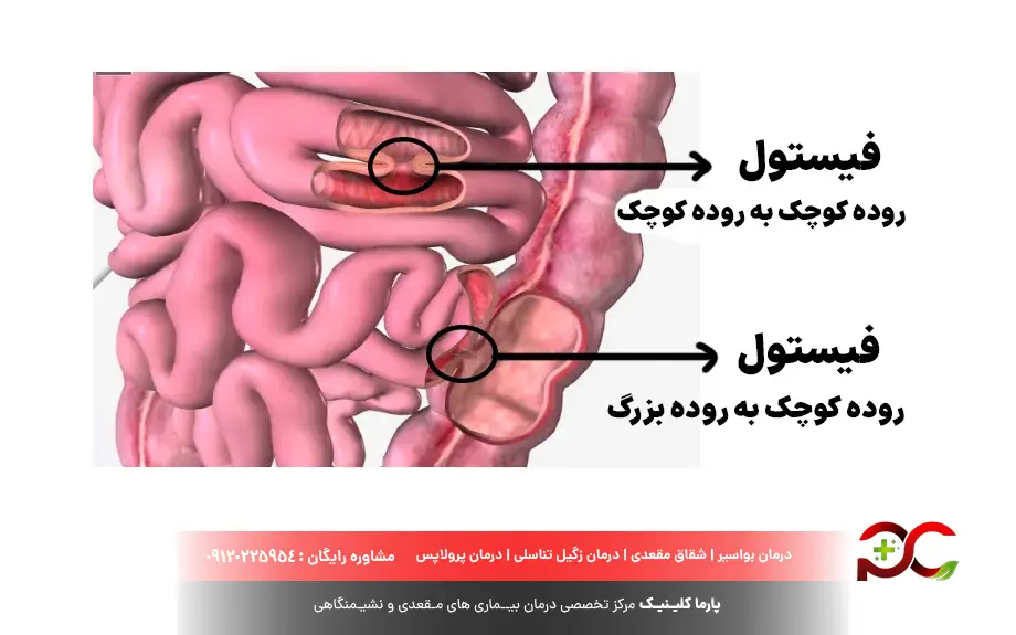 فیستول های گوارشی