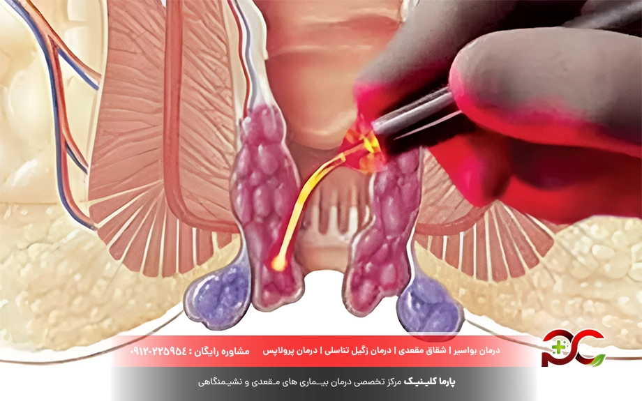 لیزر بواسیر یا هموروئید چگونه است؟