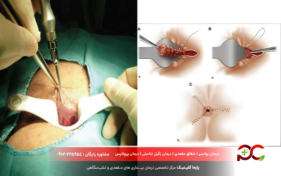 مقایسه لیزر بواسیر با جراحی سنتی