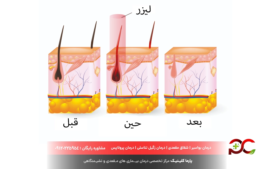 درمان کیست مویی با لیزر چگونه است؟