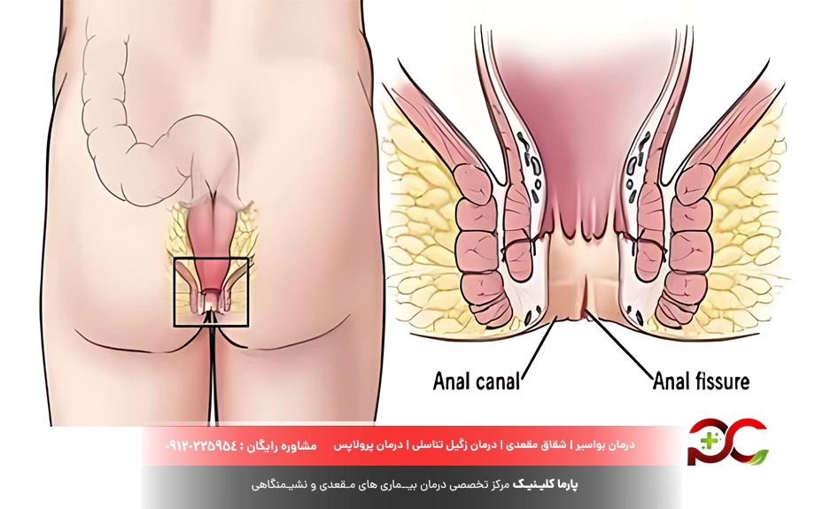 شقاق چیست؟