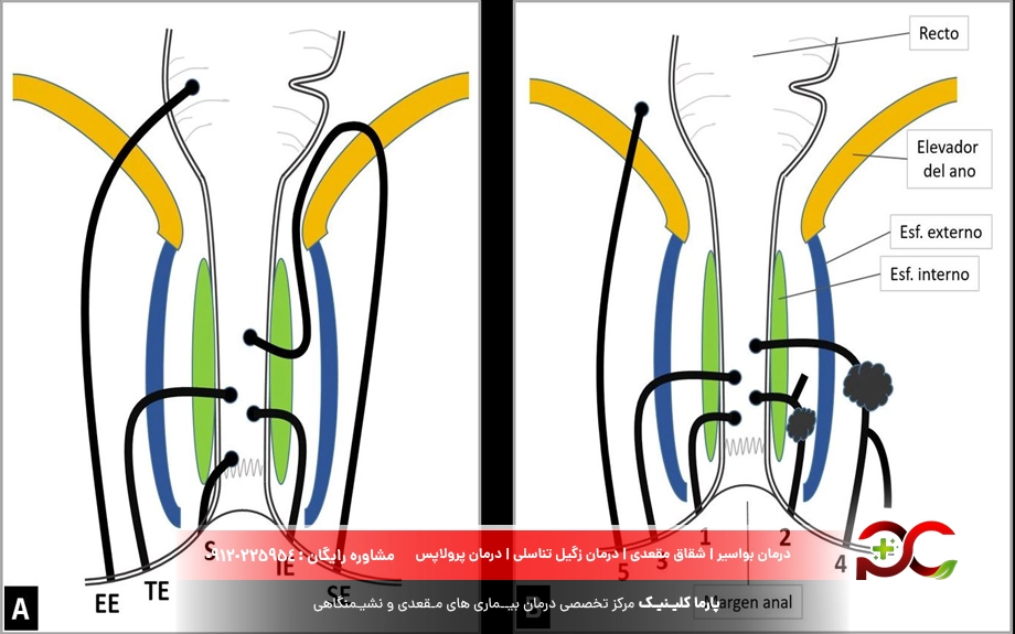 خطرات ابتلا به فیستول مقعدی