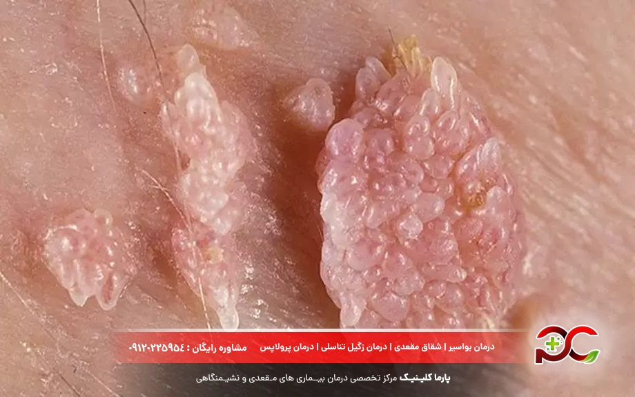 عوارض اچ پی وی یا زگیل تناسلی
