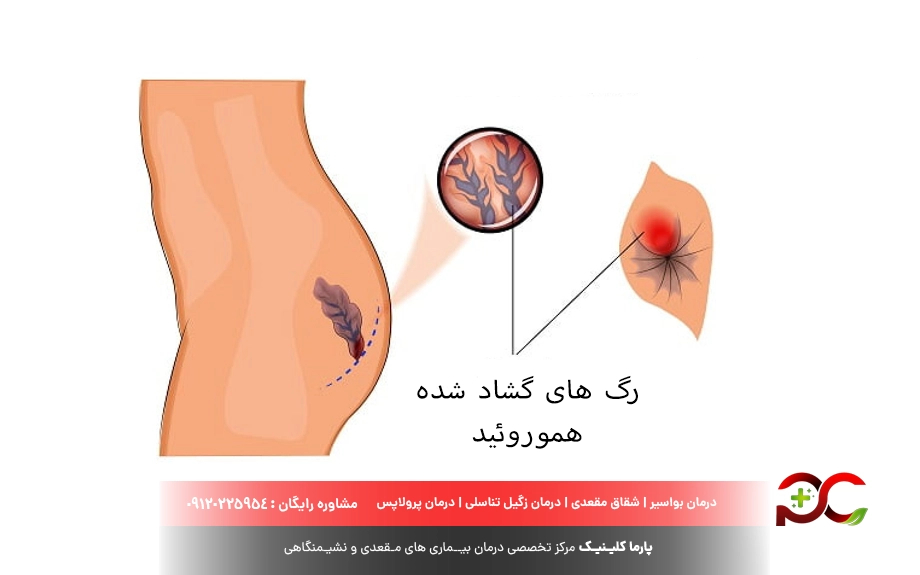 چه نوعی از بواسیر از همه خطرناک تر است؟
