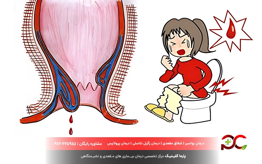 انواع بواسیر در کودکان