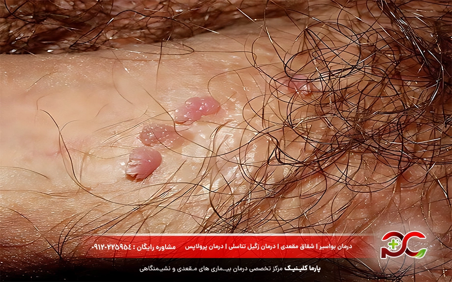 عوارض انواع زگیل تناسلی در مردان