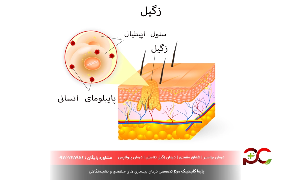 راه‌های جلوگیری از انتقال و ابتلا به زگیل تناسلی