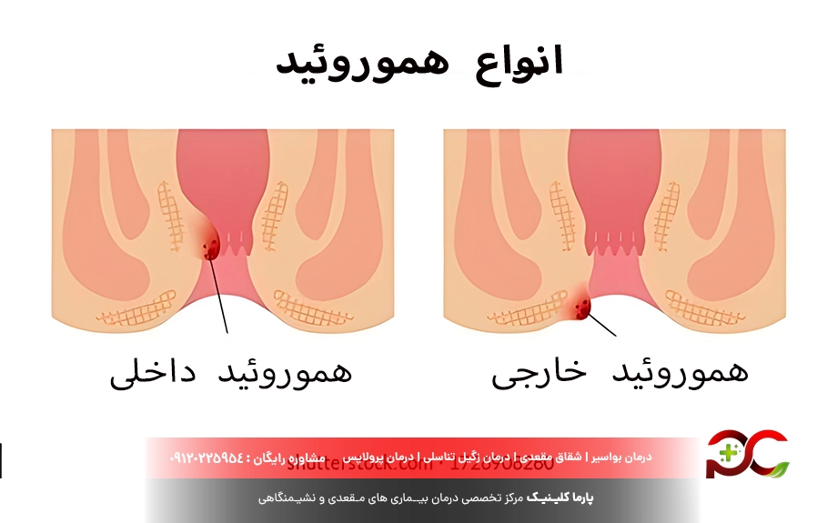 تفاوت بواسیر خارجی با داخلی 