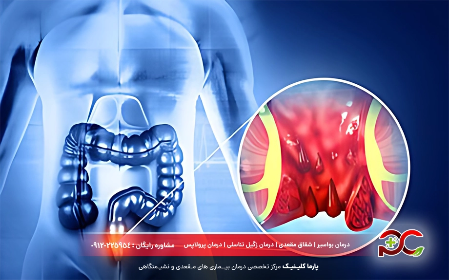 درمان بواسیر خارجی