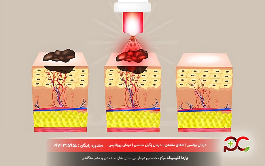 درمان زگیل تناسلی با لیزر