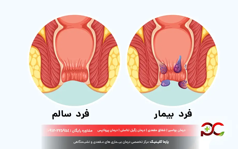 دشمن بواسیر