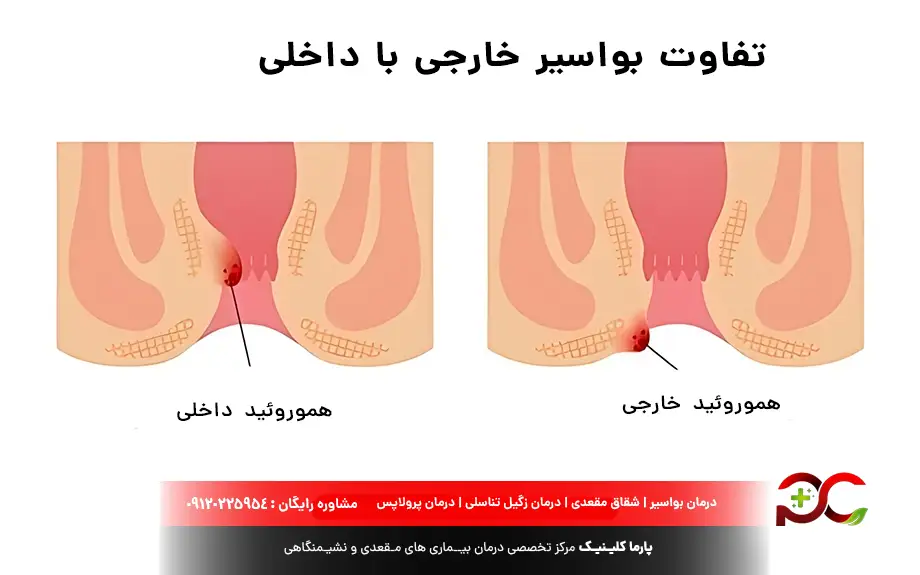 تفاوت بواسیر خارجی با داخلی