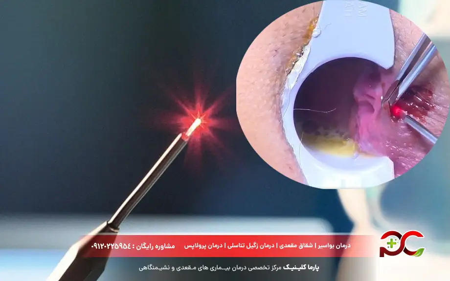 لیزر بواسیر خارجی