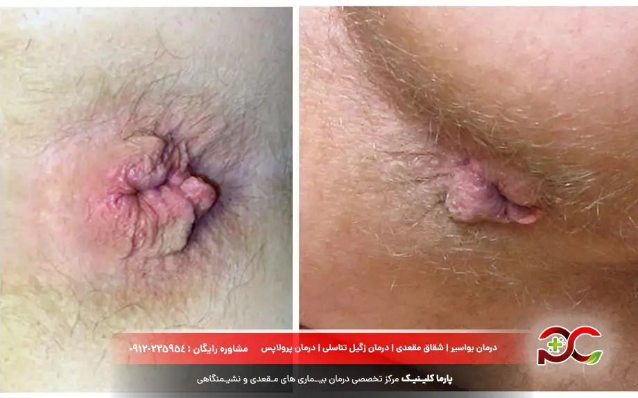 عکس بواسیر خارجی