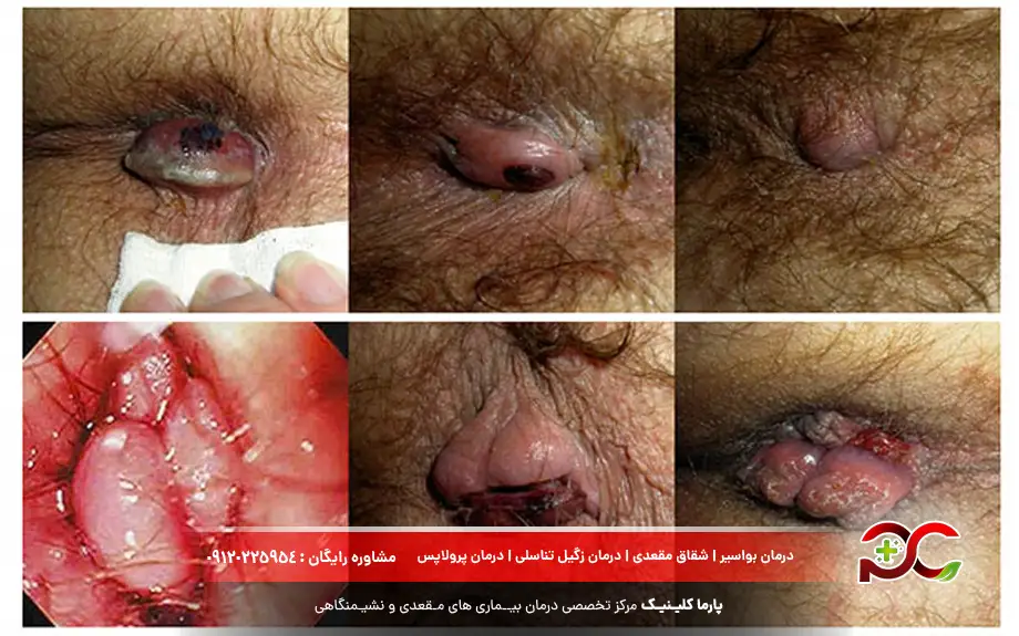 عکس بواسیر ترومبوزه