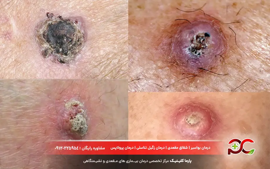 عکس سرطان کیست مویی