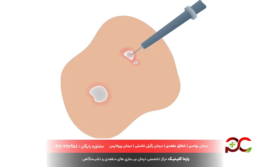 لیزر زگیل تناسلی