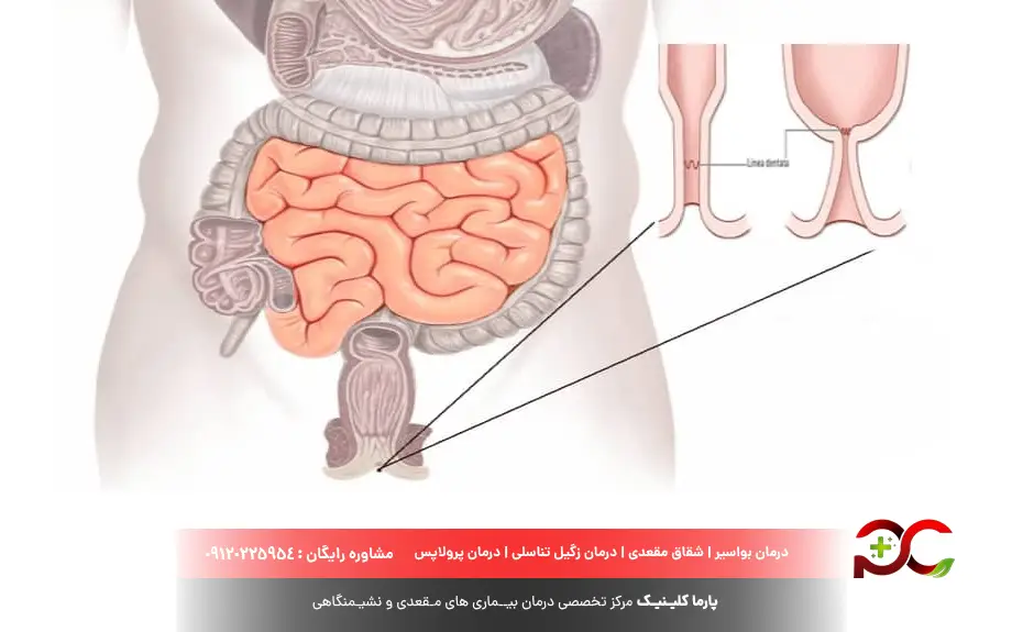 تنگی مقعد، چرا و چگونه ایجاد می شود؟ 