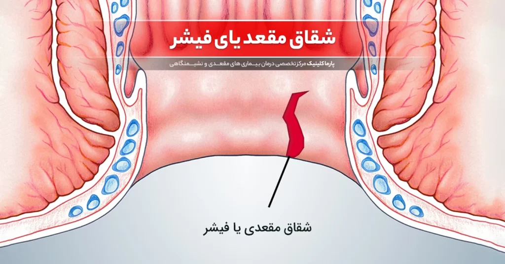 شقاق مقعدی یا فیشر چیست و چگونه تشخیص داده می‌شود؟