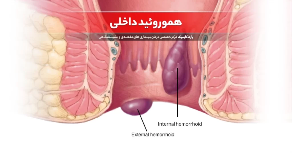 بواسیر یا هموروئید داخلی چیست و چه علائمی دارد؟