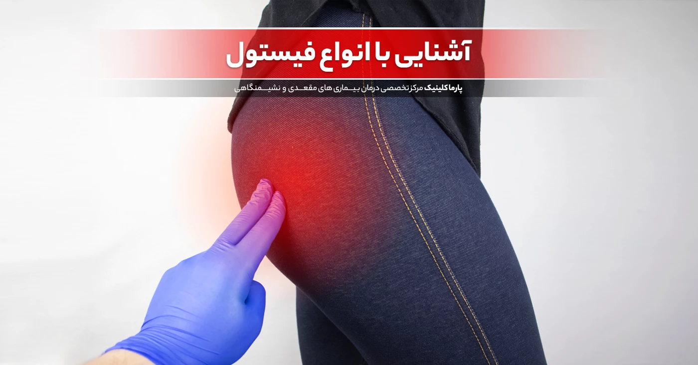 آشنایی با انواع فیستول در نقاط مختلف بدن و مقعد