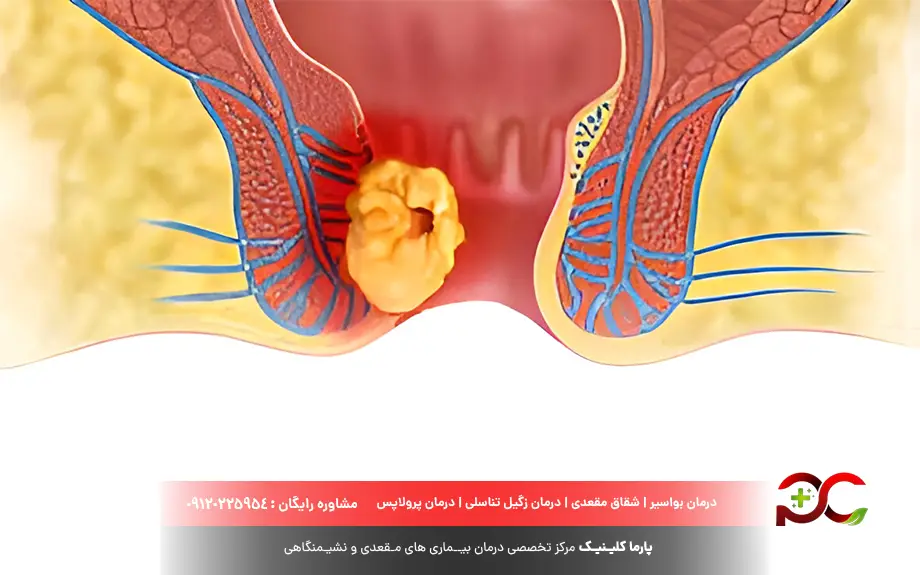 علت ایجاد توده در مقعد چیست؟