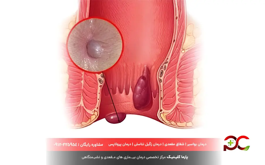 انواع مختلف گوشت اضافه مقعد