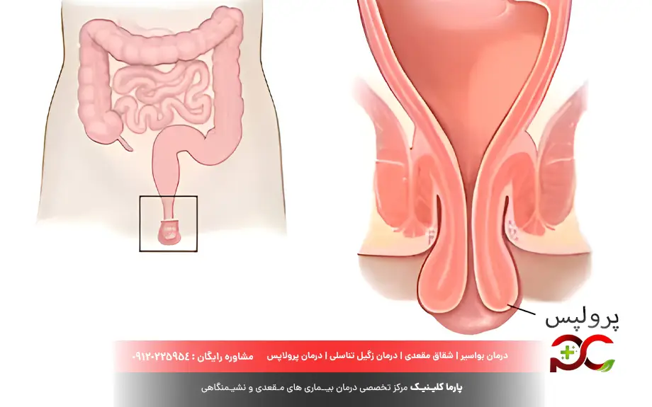 افتادگی روده یا رکتوم چیست؟