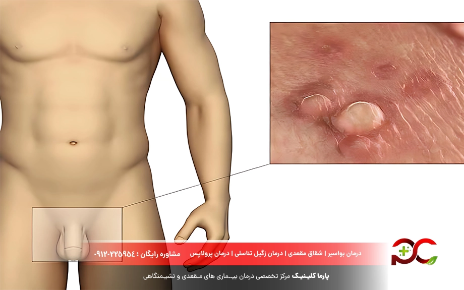 زگیل تناسلی در مردان