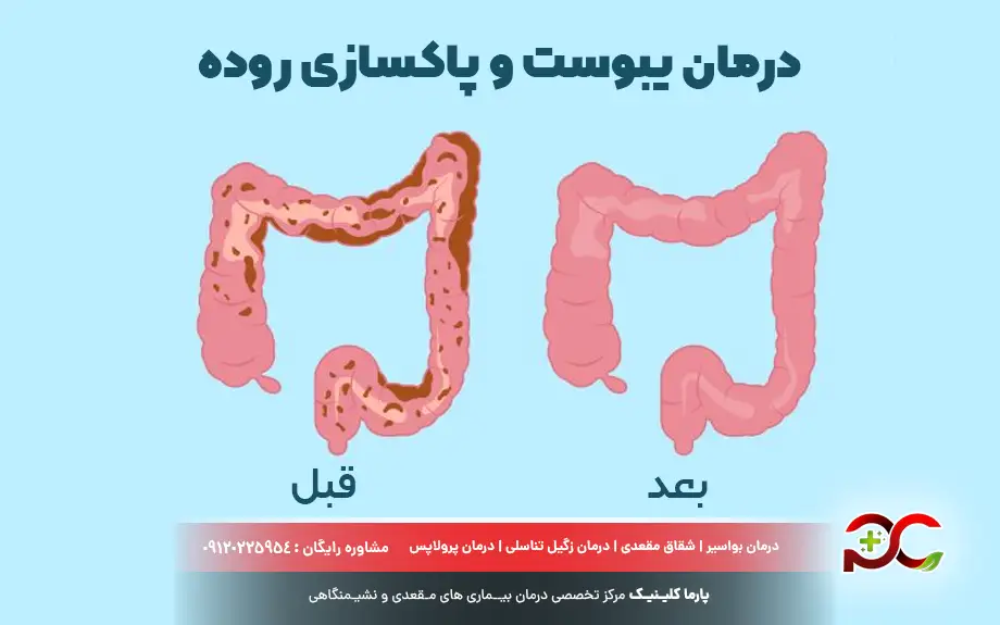 درمان یبوست و پاکسازی روده