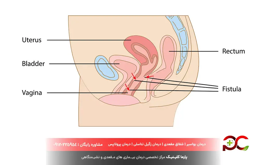 فیستول در زنان