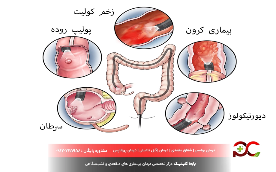 کاربرد آزمایش کولونوسکوپی