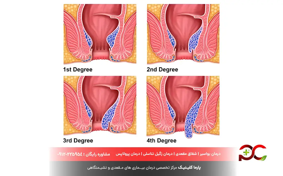 درجات بواسیر