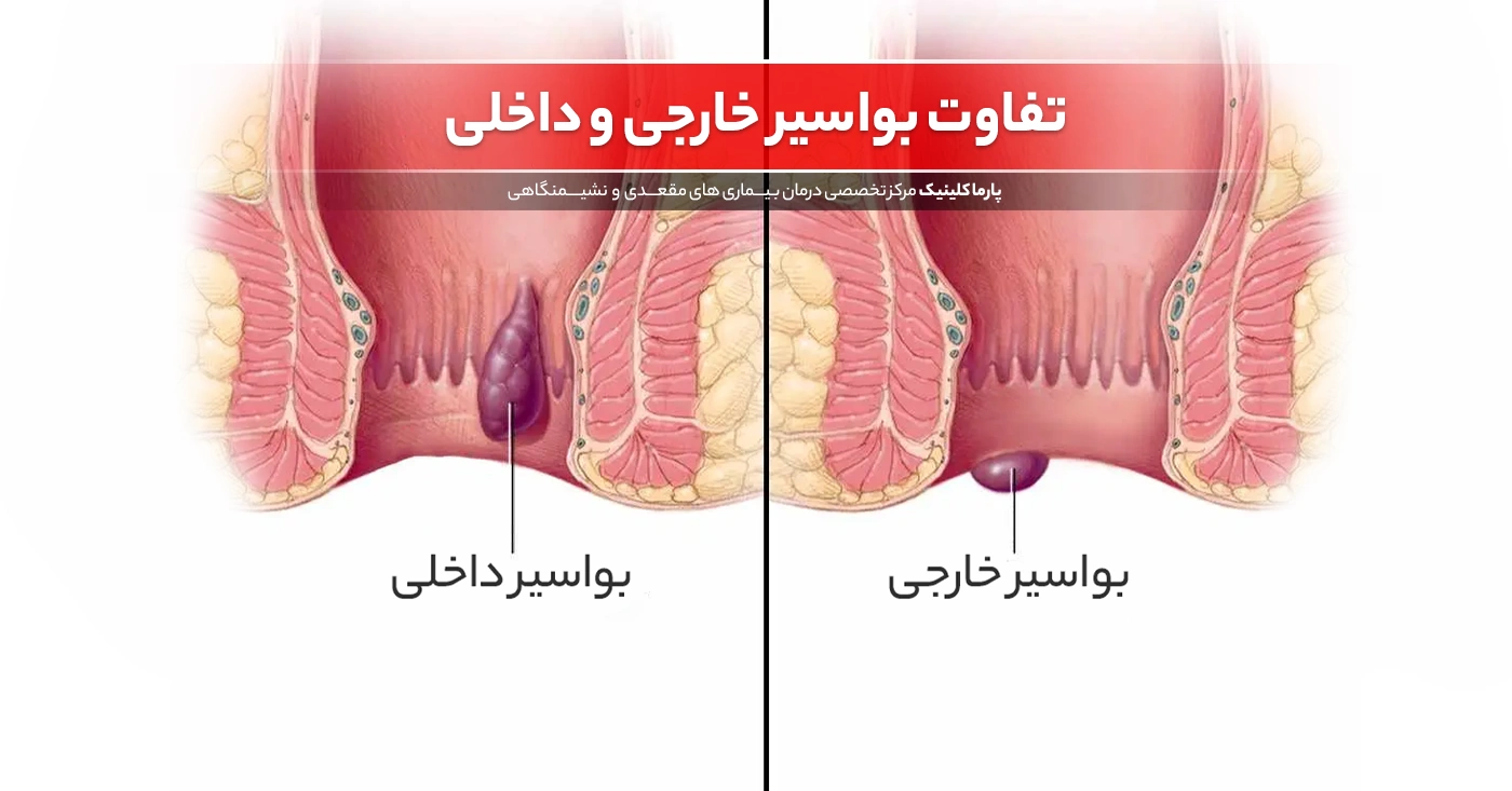 تفاوت بواسیر خارجی و داخلی: کدام خطرناک تر است؟