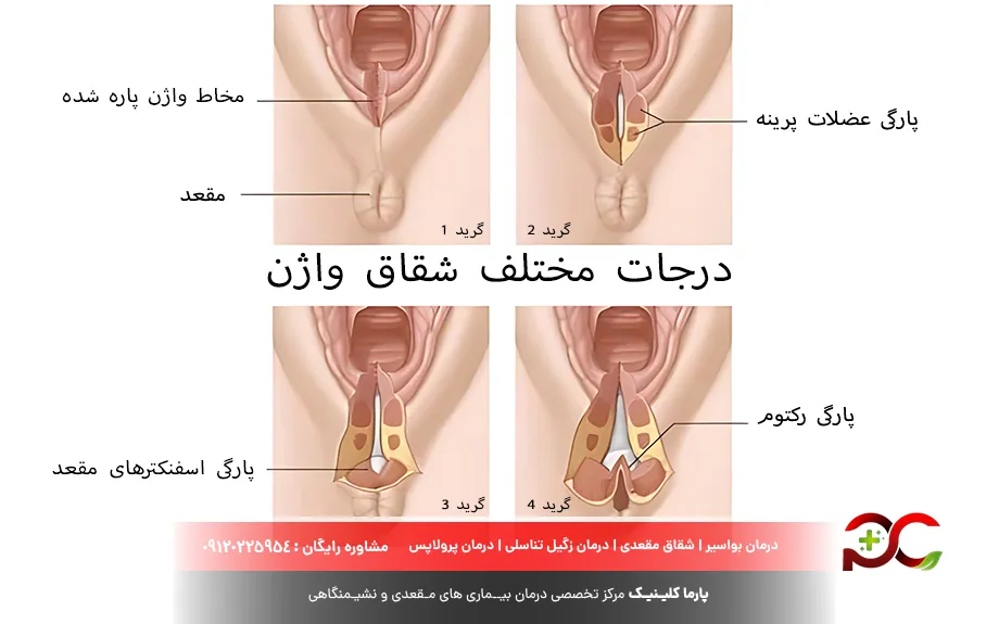 بررسی انواع زخم واژن