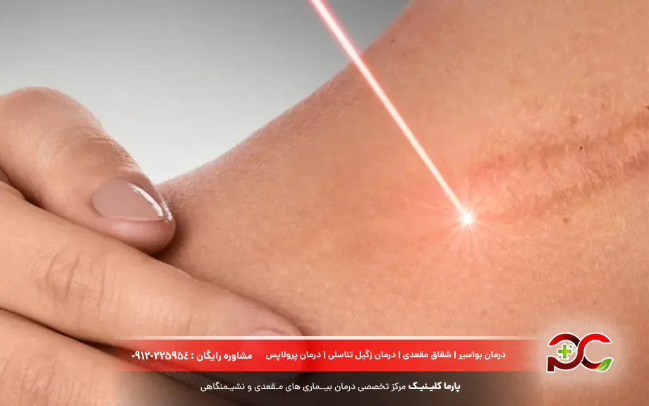 لیزر شقاق واژن
