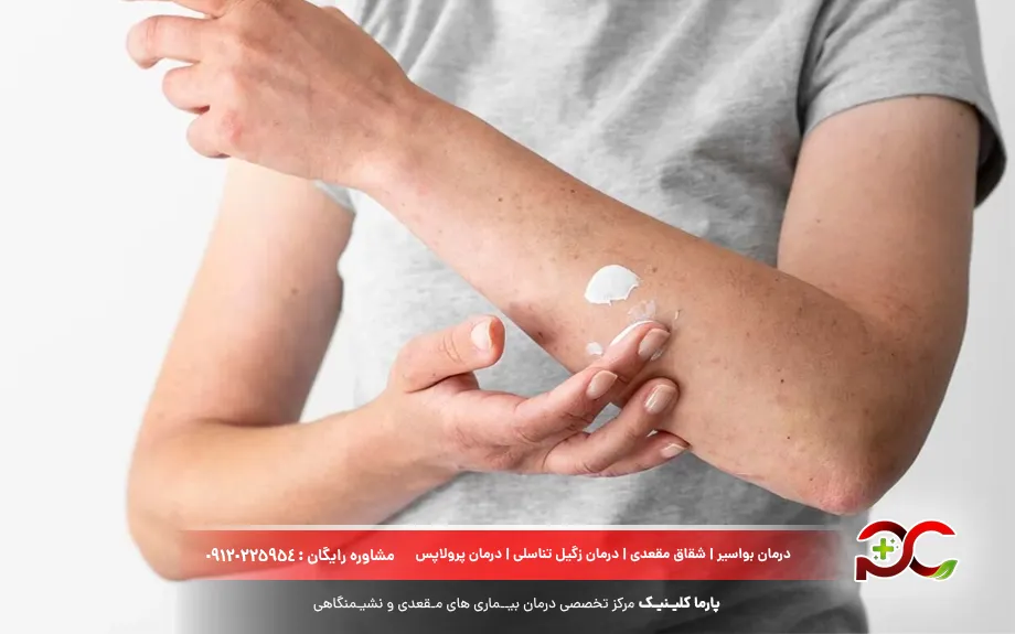 پماد هیدروکورتیزون برای قارچ پوستی