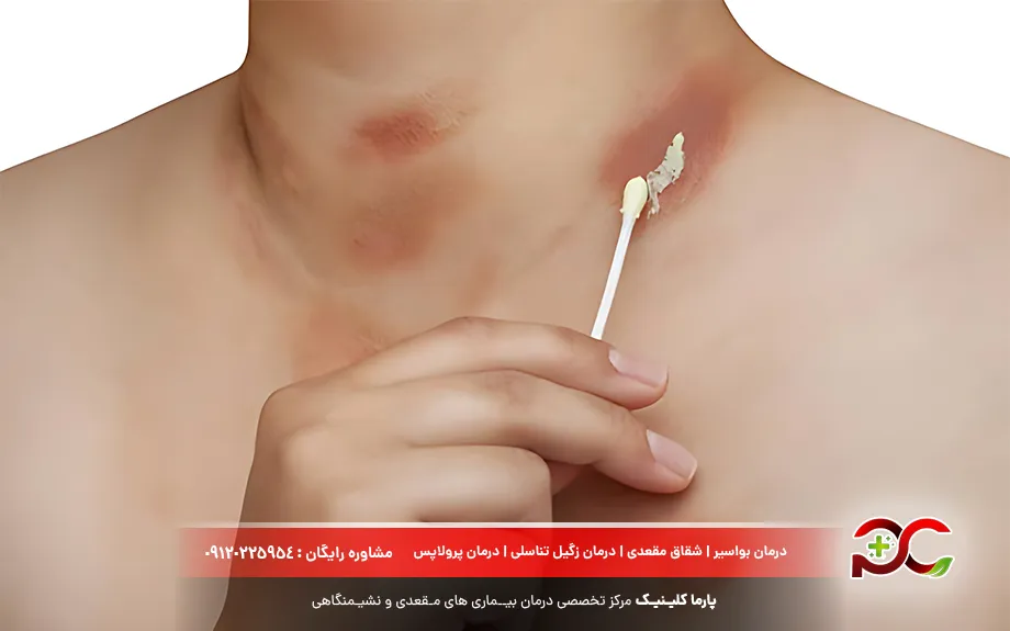 پماد تتراسایکلین برای سوختگی