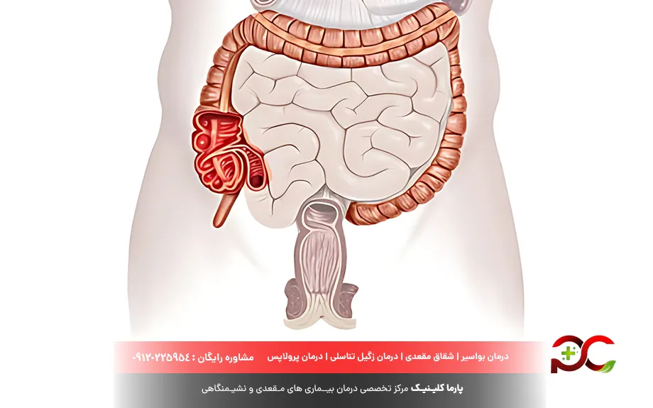 گشادی مقعدی یک بیماری مجزا نیست